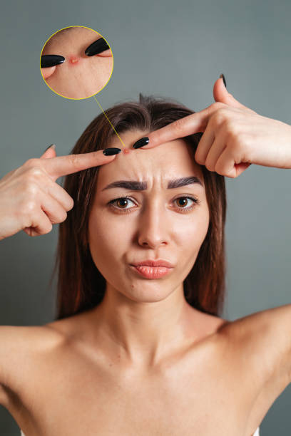 How to Prevent Acne? Simple Tips You Need To Know!