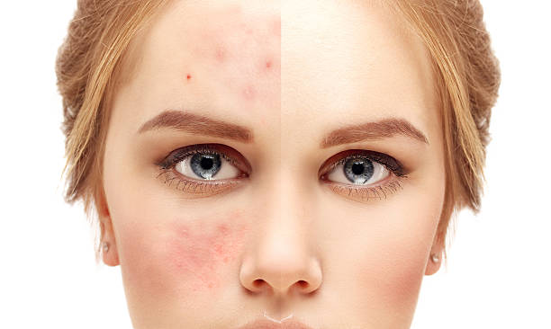 Natural Home Remedies for Acne