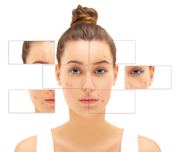 Types of Acne and How to Treat Them
